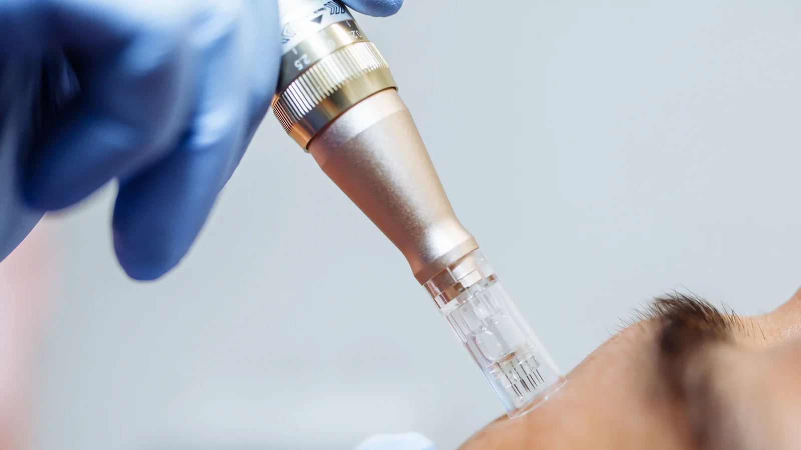 Chasing Glow With Fragile Skin: How to Navigate Acids, Retinol and Microneedling Safely