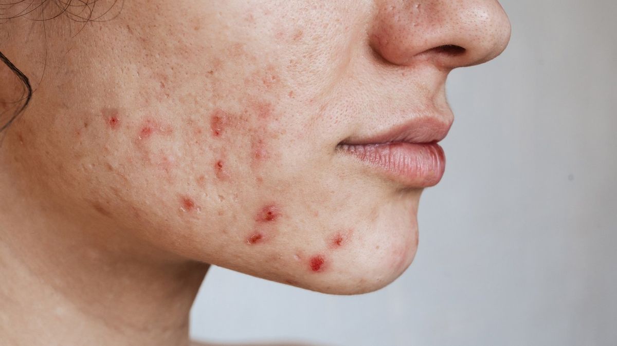 Viral Skincare Trends vs. Oily Skin: What Actually Helps and What Makes You Break Out