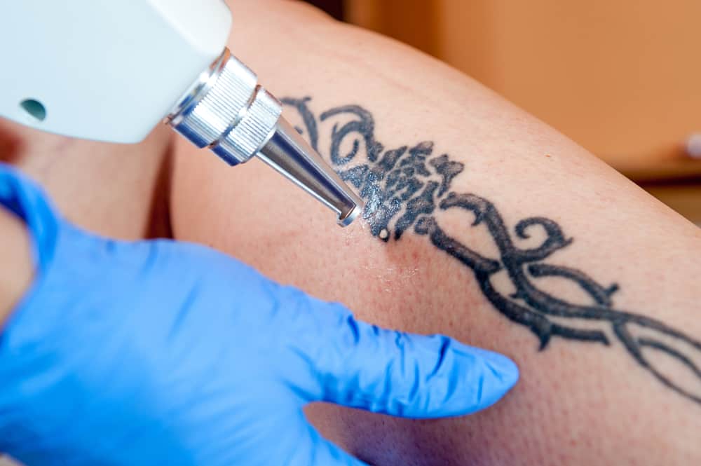 The Tattoo Removal Reality Check: Sessions, Timelines, and What You’re Really Signing Up For