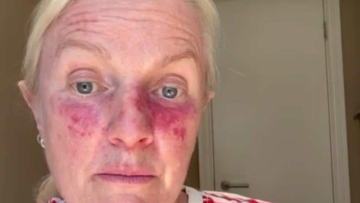 When a Skin Patch Signals Something Serious: How Misdiagnosis Delays Treatment