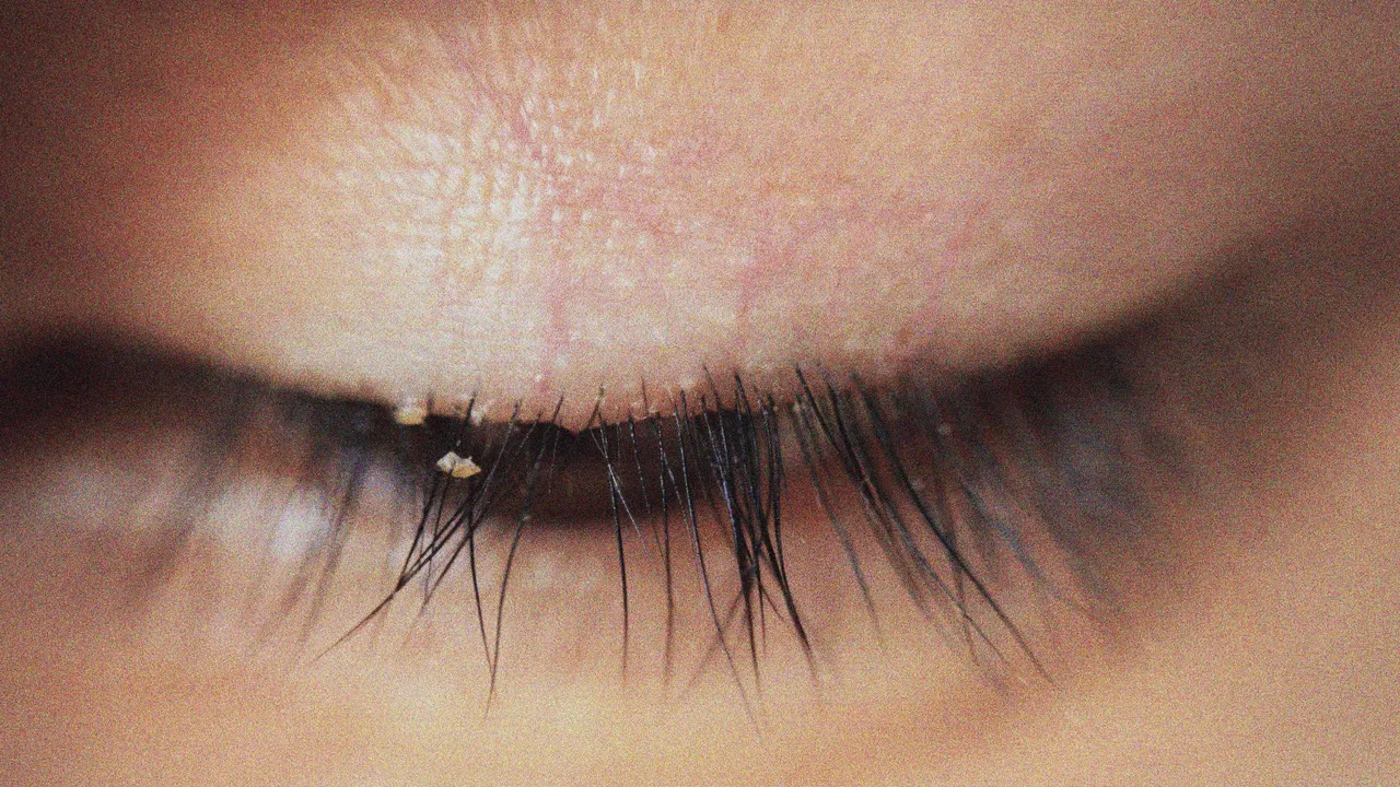 Could Eyelash Mites Be Triggering Your Rosacea? What Skin and Eye Experts Want You to Know