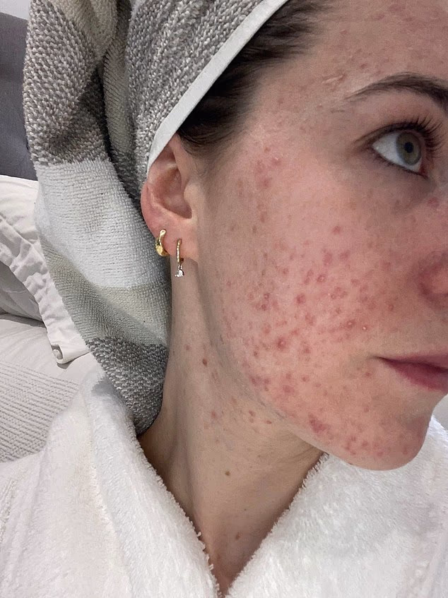 How I Treated Severe Cystic Acne Before My Wedding: A Step‑by‑Step Recovery Plan