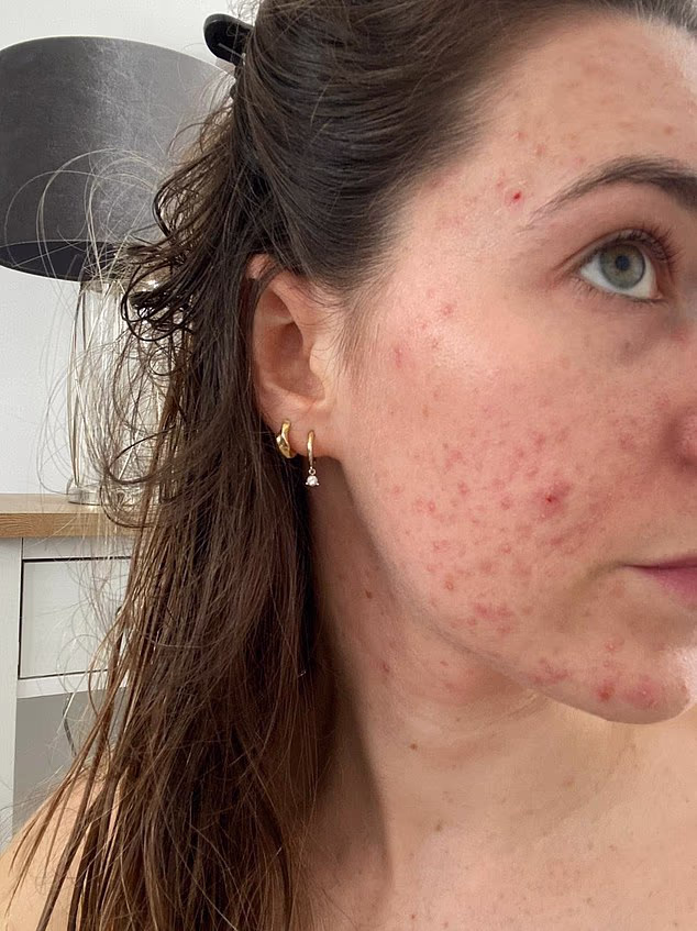 How I Treated Severe Cystic Acne Before My Wedding: A Step‑by‑Step Recovery Plan