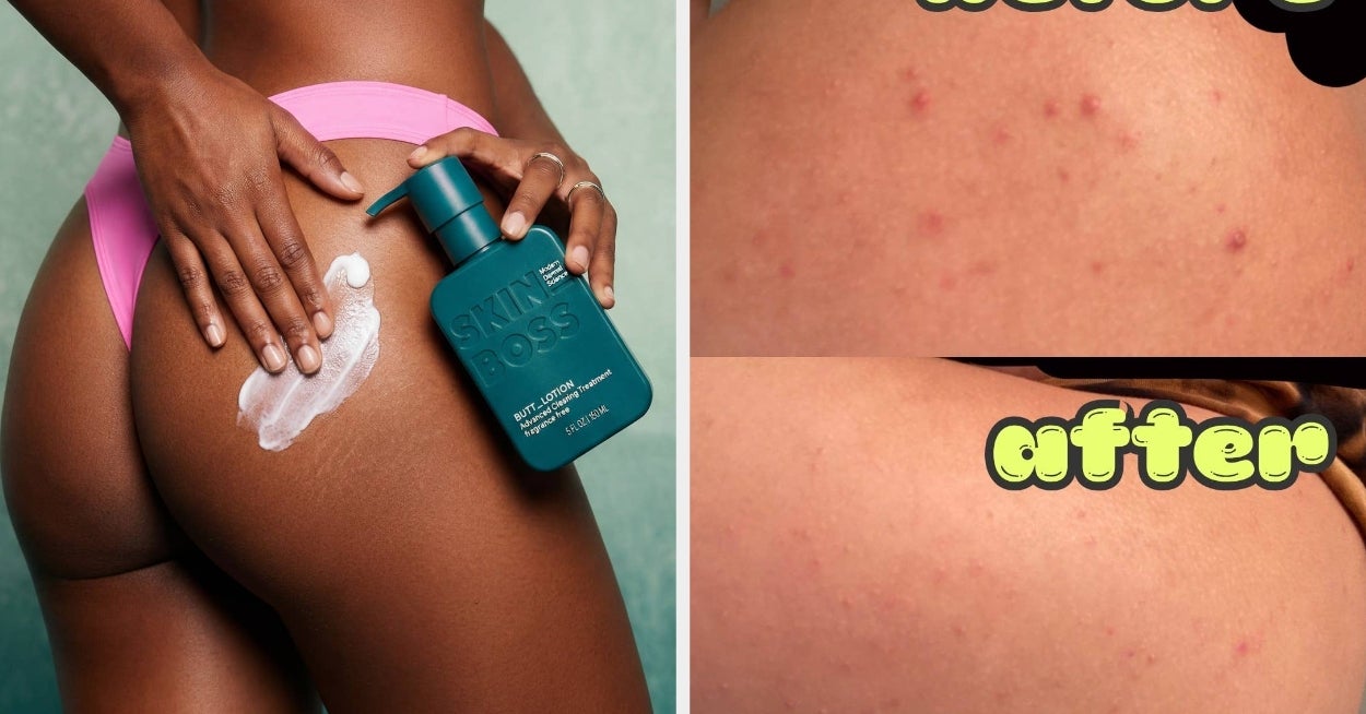 The Complete Guide to Treating Acne Everywhere But Your Face