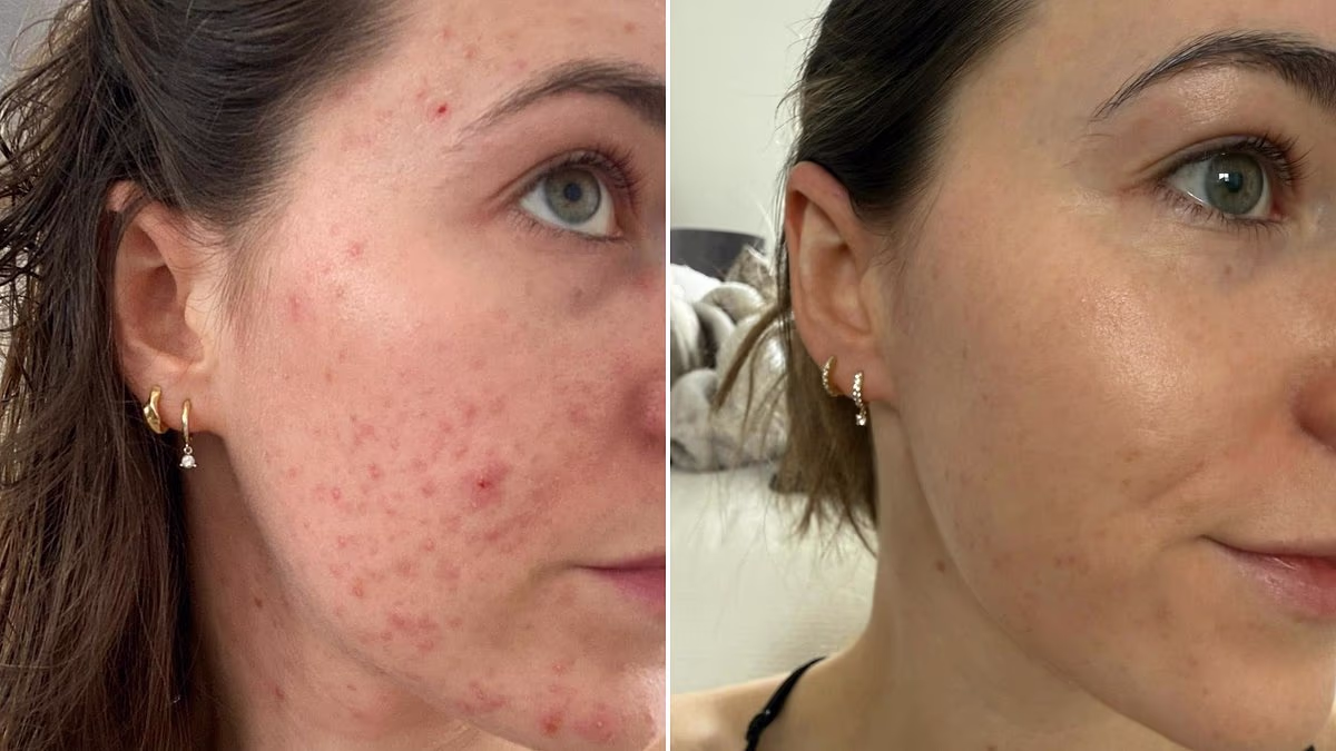 How I Treated Severe Cystic Acne Before My Wedding: A Step‑by‑Step Recovery Plan