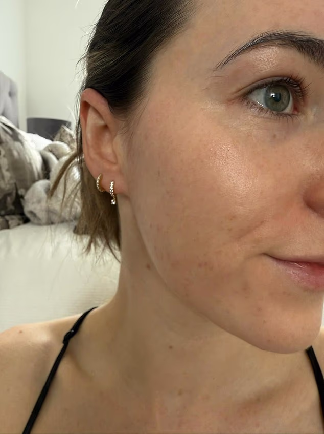 How I Treated Severe Cystic Acne Before My Wedding: A Step‑by‑Step Recovery Plan