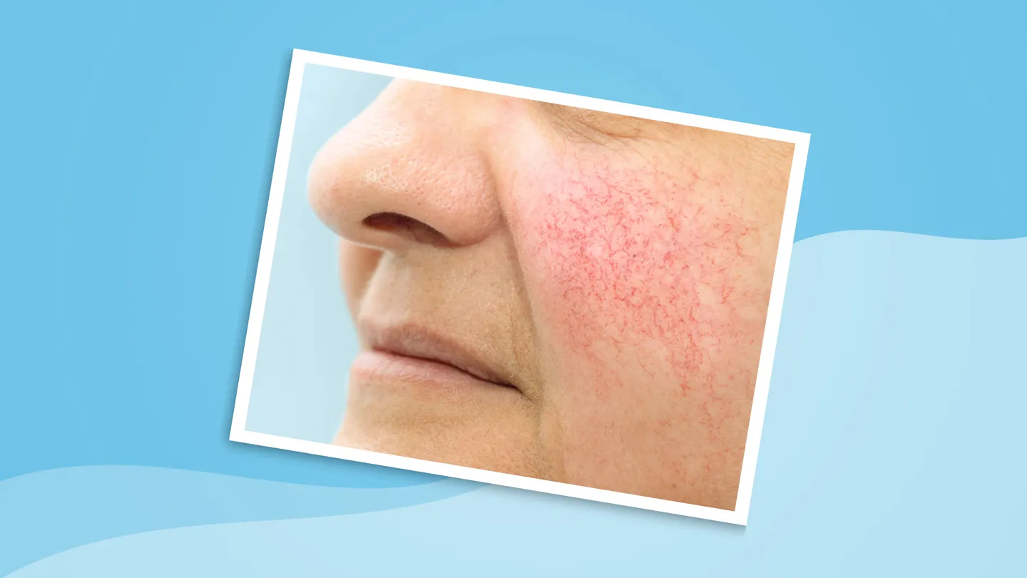 Why Menopause Makes Rosacea Worse—and What You Can Do About It