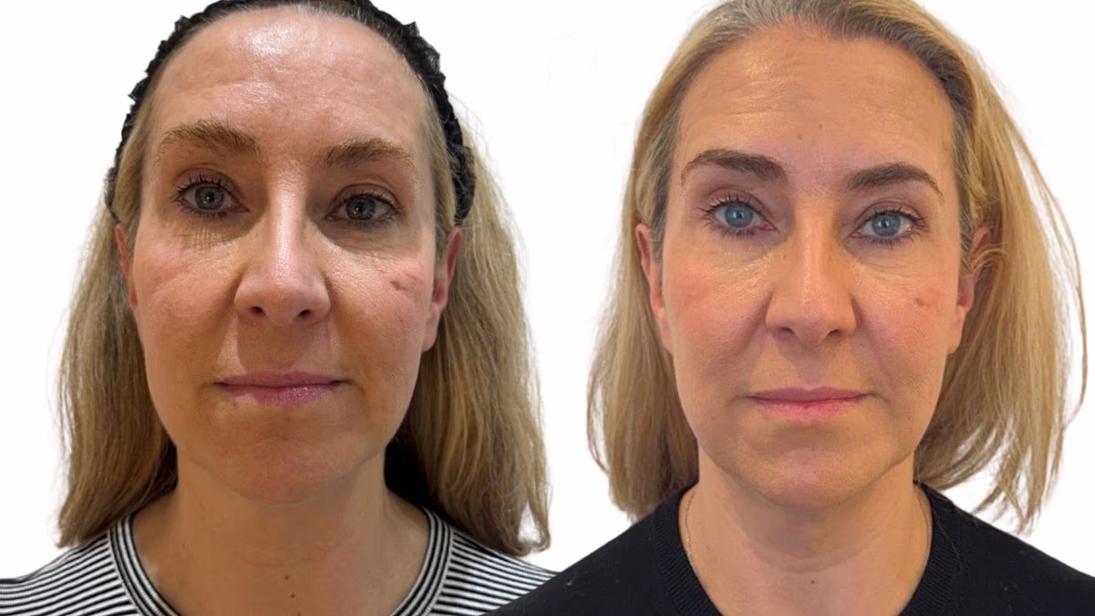 Non-Surgical Face Lifting: Instant Lift or Short-Lived Fix?