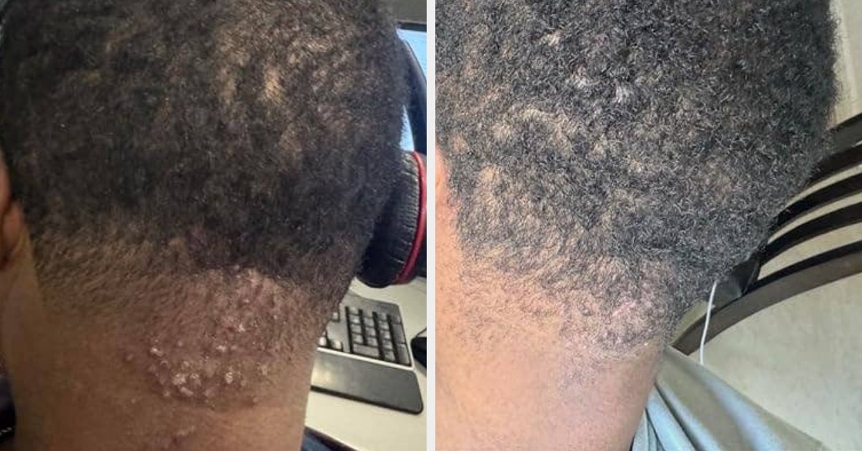 The Complete Product Guide to Eliminating Ingrown Hairs and Razor Bumps