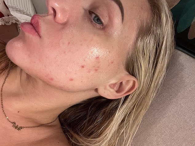 Adult-Onset Acne: Why It Appears Later and What Works