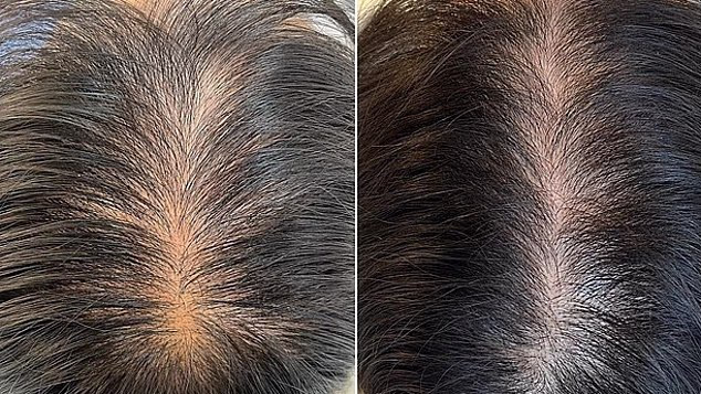 Scalp Care Is Becoming the New Frontier in Hair Loss Treatment