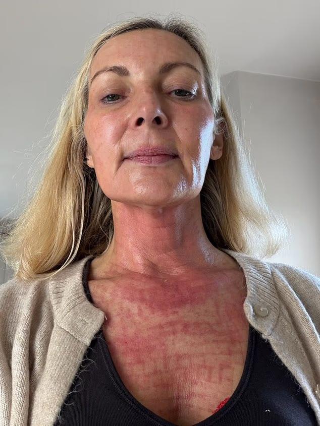 How Non-Surgical Treatments Tightened My Crepey Neck and Chest