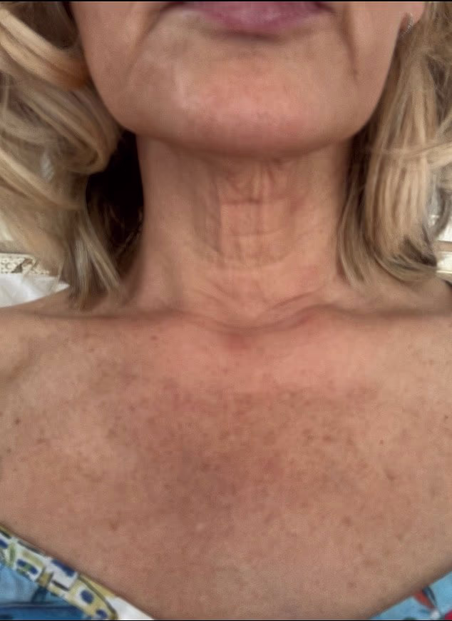 How Non-Surgical Treatments Tightened My Crepey Neck and Chest