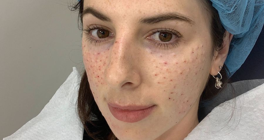 PDRN and Rejuran Facials: What Dermatologists Want You to Know