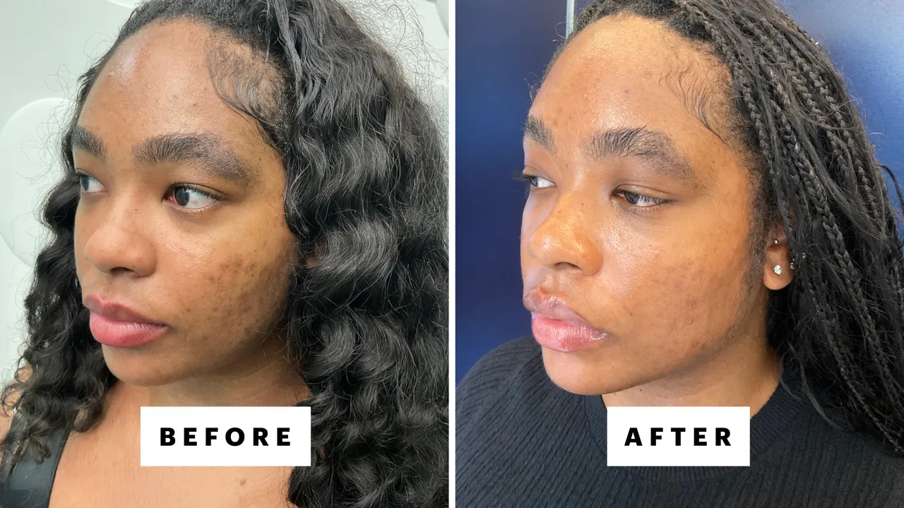 Which Laser Treatment Actually Works for Your Skin Tone?
