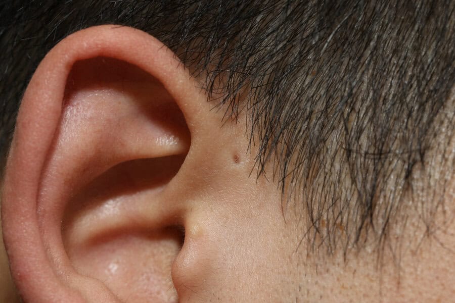 FUE vs. FUT Hair Transplants: Which Surgery Makes Sense Under 40?