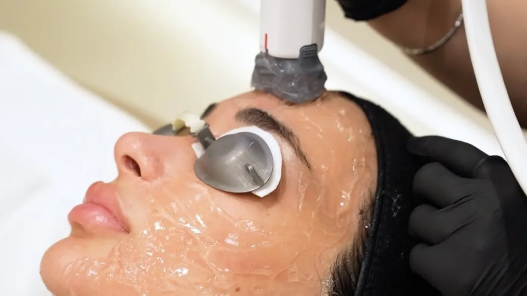 Which Laser Treatment Actually Works for Your Skin Tone?