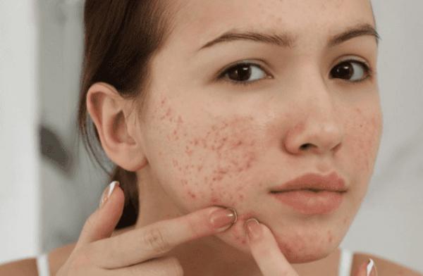 3 hoạt chất thiết yếu giúp kiểm soát mụn và dầu thừa hiệu quả