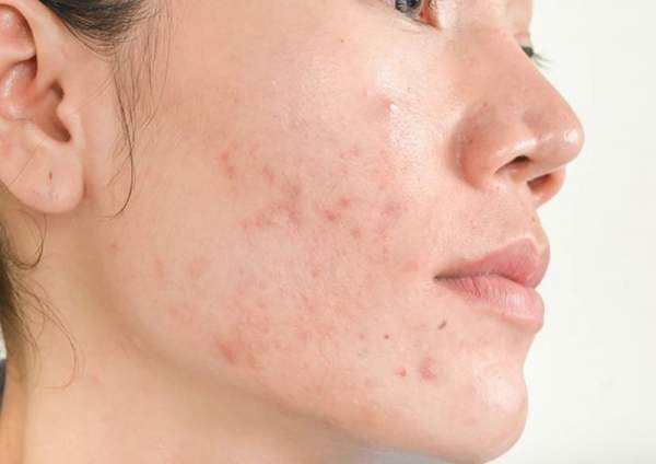 3 hoạt chất thiết yếu giúp kiểm soát mụn và dầu thừa hiệu quả