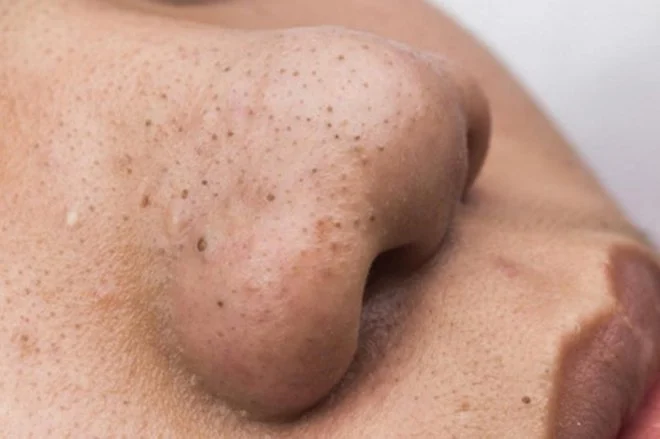 6 thói quen skincare khiến mụn đầu đen tái phát và cách sửa