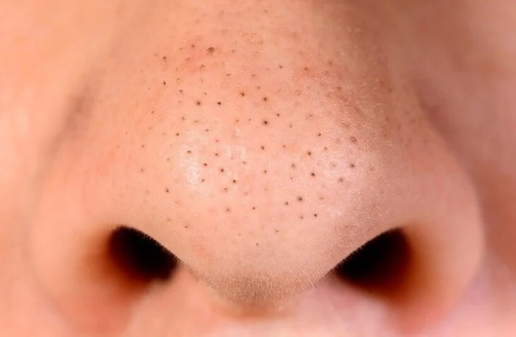 6 thói quen skincare khiến mụn đầu đen tái phát và cách sửa