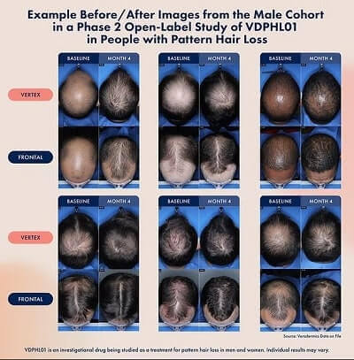 Minoxidil vs hợp chất mới: giải pháp nào đáng tin cho rụng tóc?