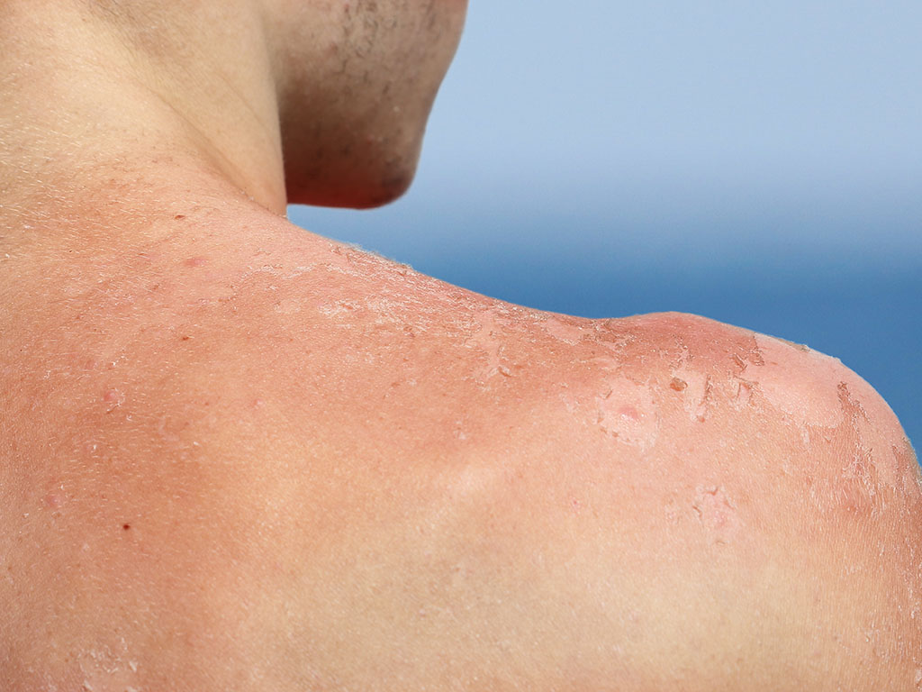 From Painful Sunburn to Skin Cancer: Why Prevention Matters Now