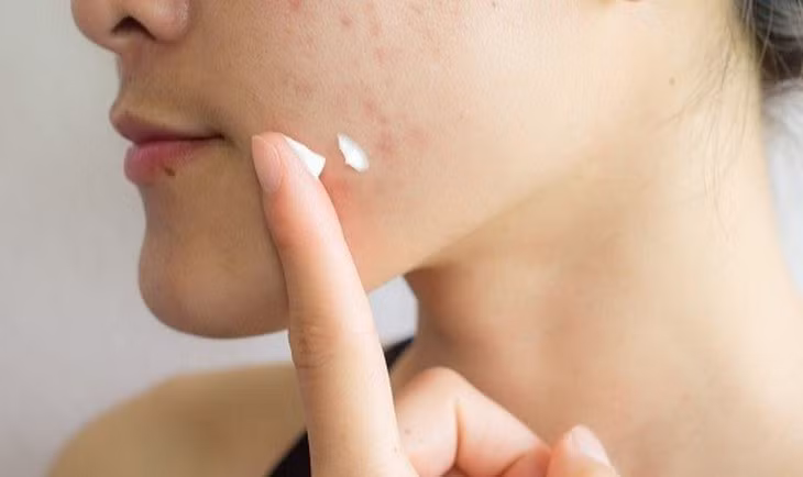 Thu hồi 5 mỹ phẩm Kencare: Lỗ hổng hồ sơ PIF và bài học cho người tiêu dùng