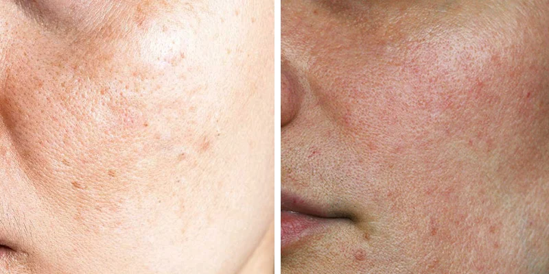 3 bước chăm sóc da giúp cải thiện nám sau sinh và làm sáng da