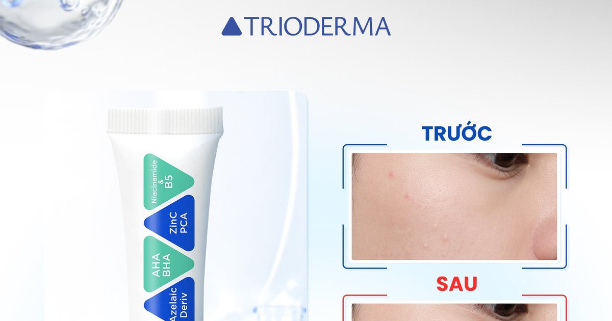 Trioderma Anti Acne Gel: kem chấm mụn viral có đáng tiền?