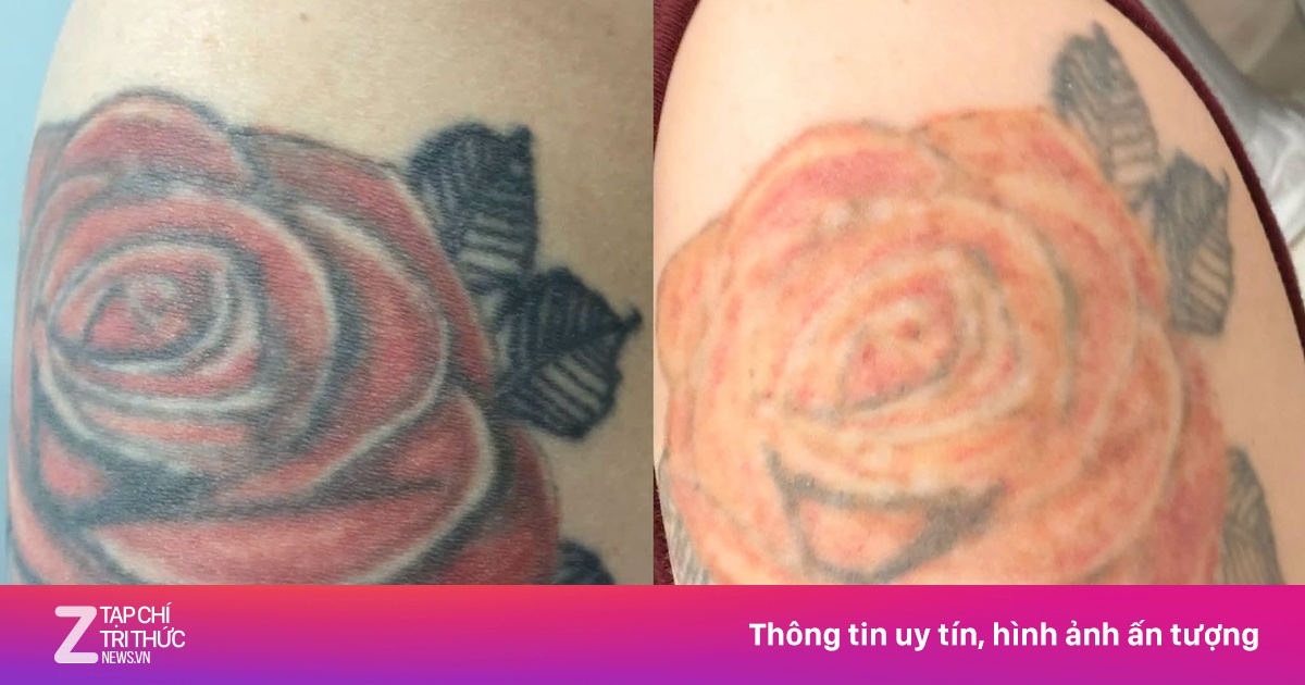 Xóa hình xăm kéo dài bao lâu và những cảnh báo không nên bỏ qua