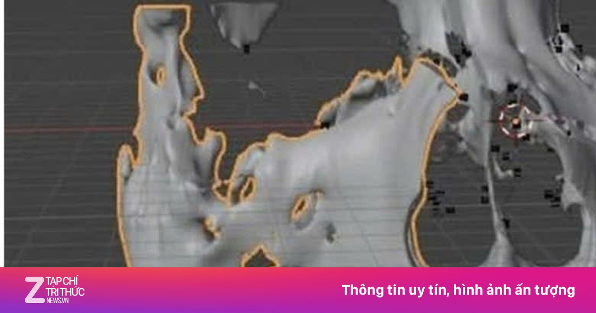 Khối sưng má không đau: Đừng để ung thư hàm mặt âm thầm “ăn” nửa khuôn mặt