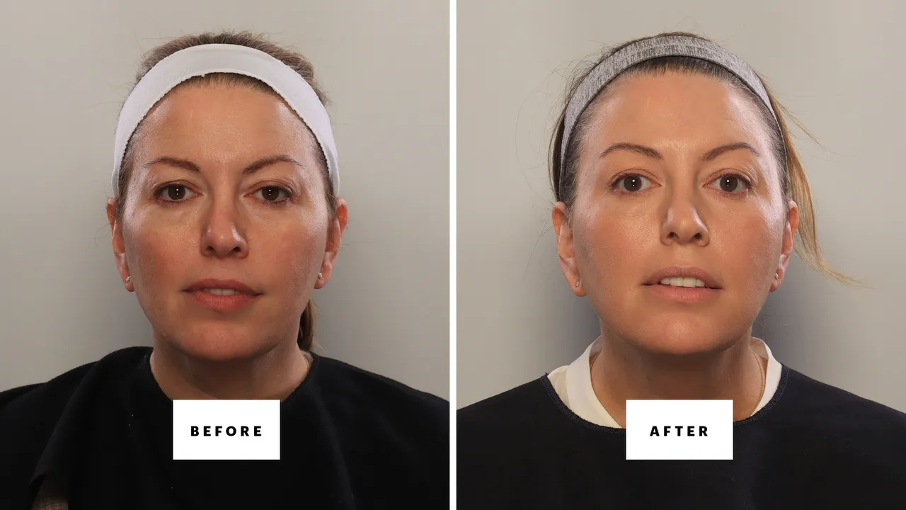 Eye Drops vs Devices: The New Non-Surgical Lid Lift
