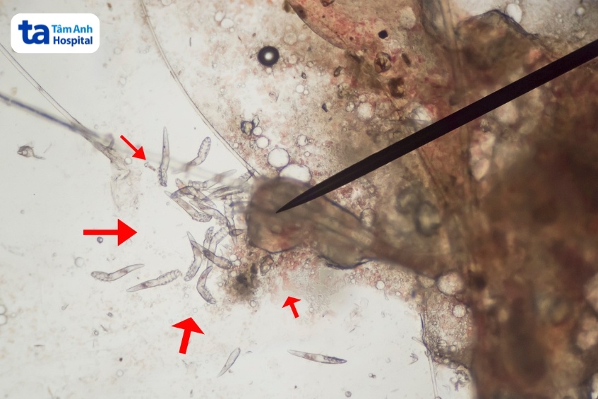 Viêm da Demodex: chẩn đoán chính xác và tránh nhầm với da nhiễm corticoid