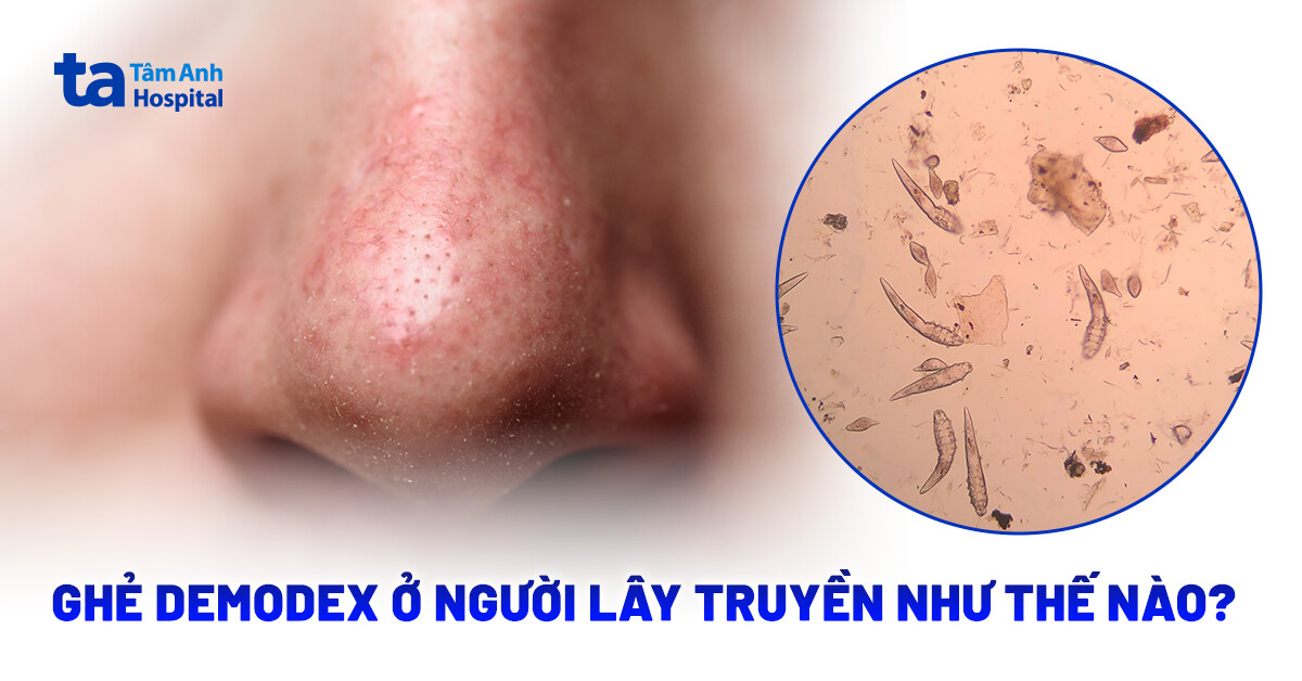 Viêm da Demodex: chẩn đoán chính xác và tránh nhầm với da nhiễm corticoid