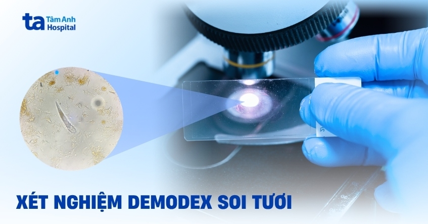 Viêm da Demodex: chẩn đoán chính xác và tránh nhầm với da nhiễm corticoid