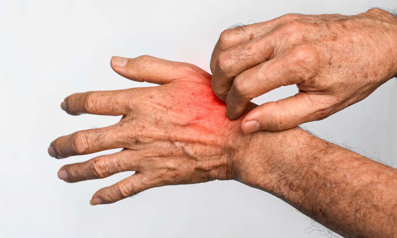 Why Ceramide-Rich Moisturizers Beat Generic Hydration for Eczema