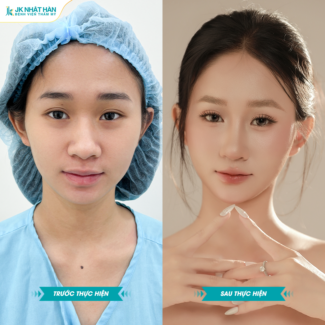 Nâng mũi sụn sườn J-Cos: Kỳ vọng và thực tế