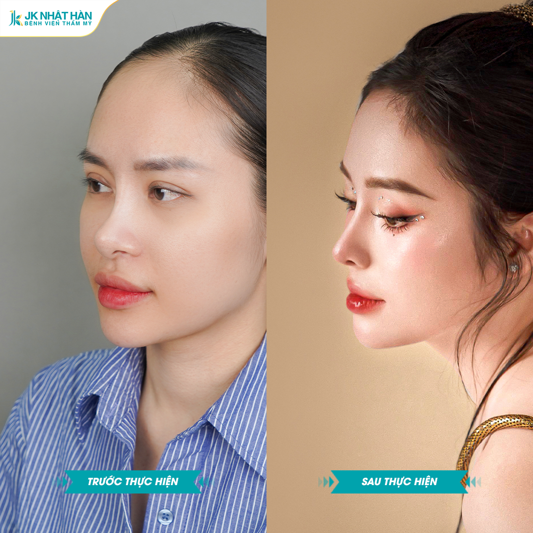 Nâng mũi sụn sườn J-Cos: Kỳ vọng và thực tế