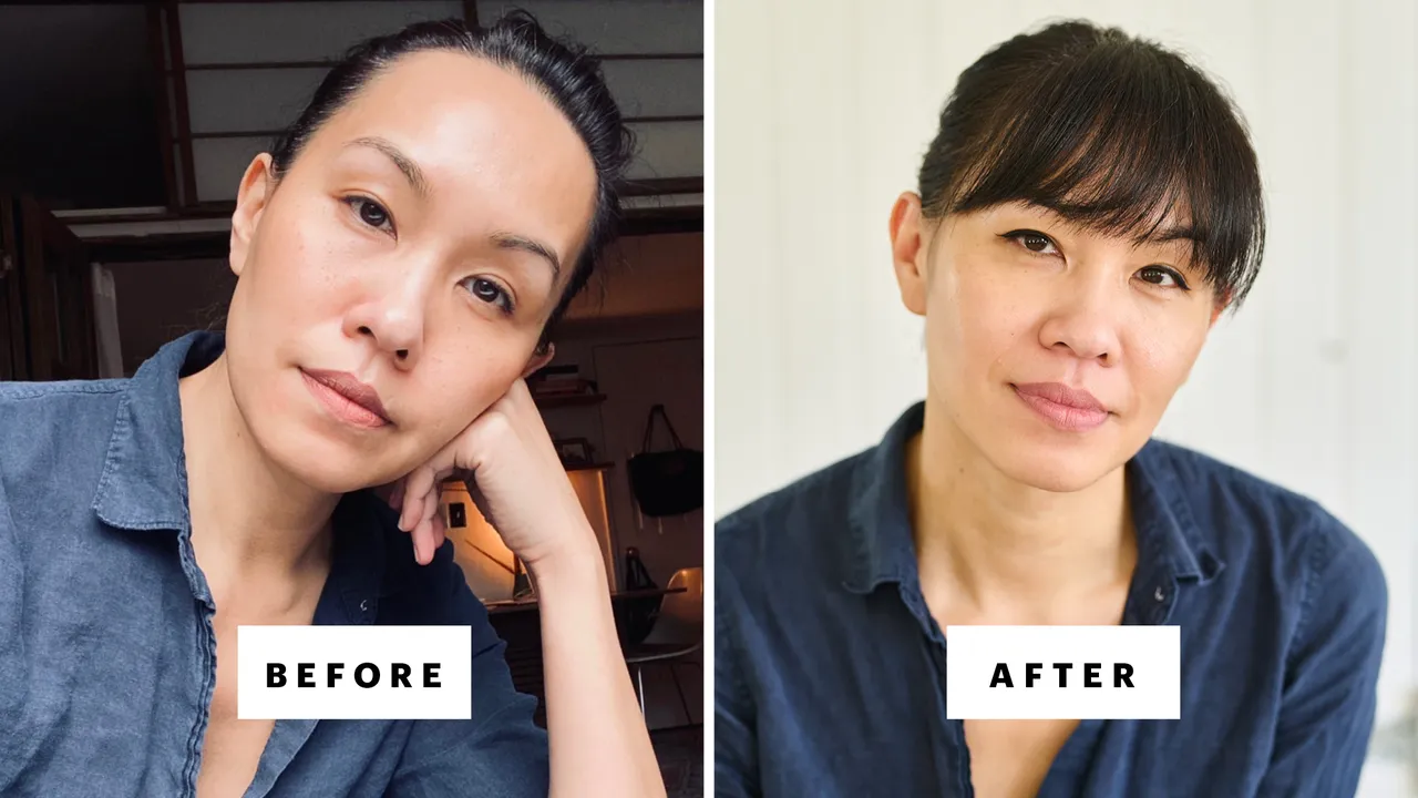 GLP-1 Weight Loss, Facial Aging, and the Case for Fat Injections