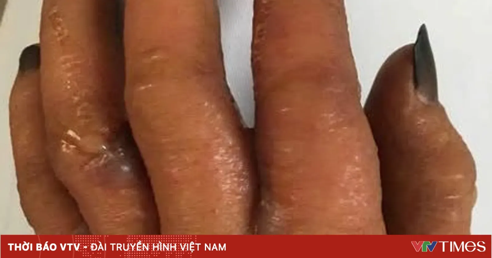 Nhuộm tóc tại nhà mà quên găng tay: cái giá của sự chủ quan