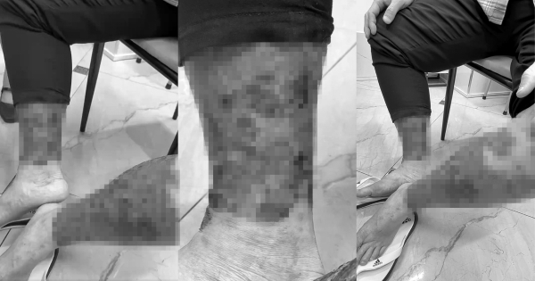 Tự chữa bệnh da bằng lá cây: cái giá là bội nhiễm và suy gan tiềm ẩn