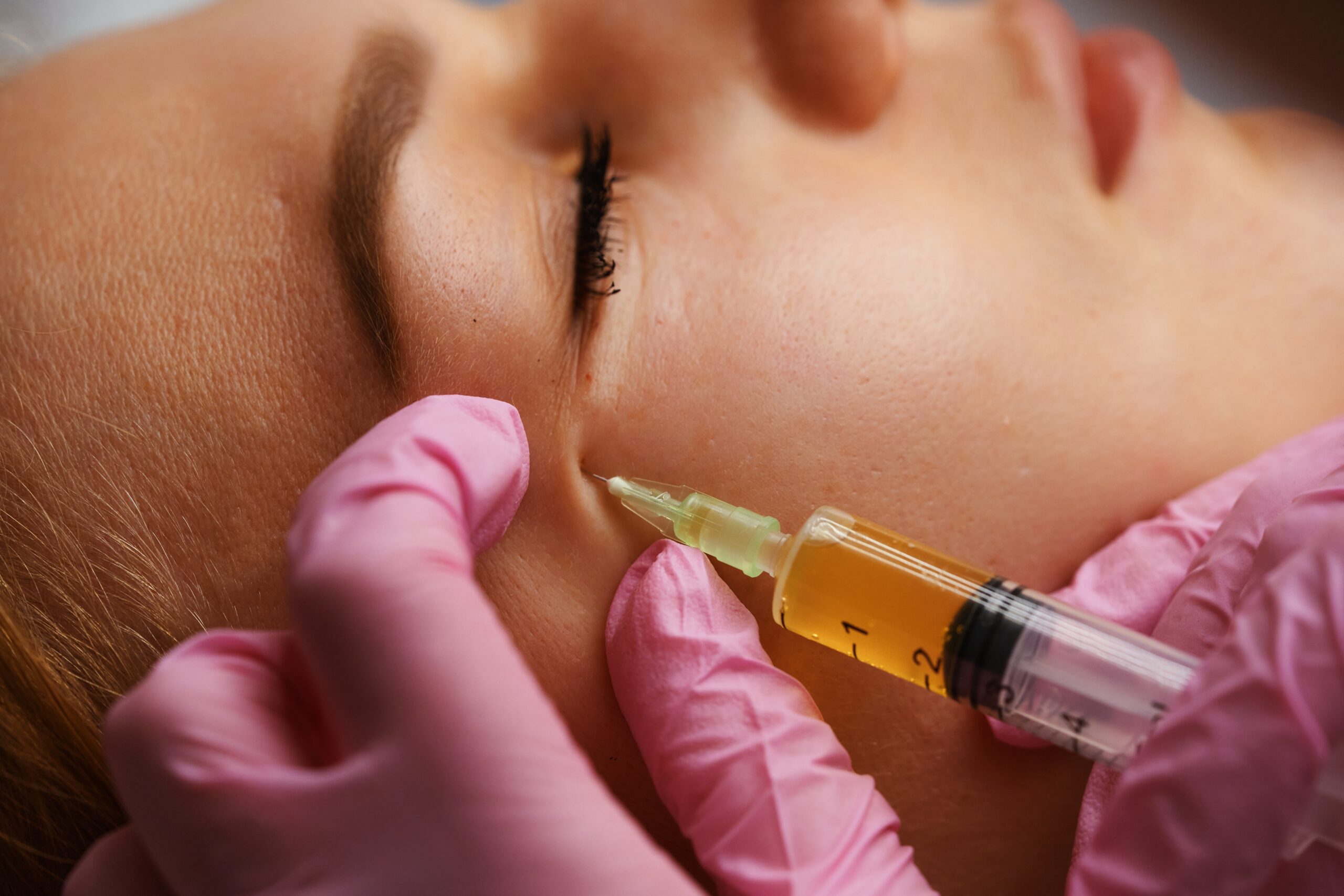 Mastering Injectable Precision Around the Eyes