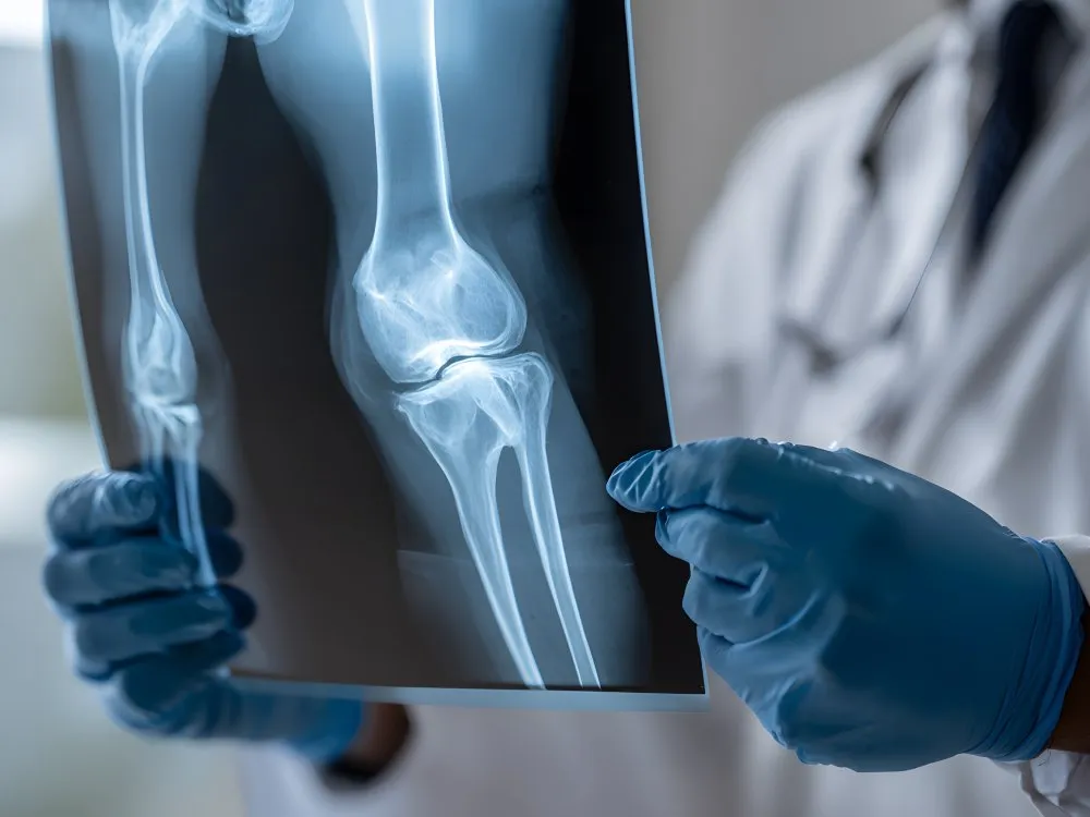 Why Young Adults Are Developing Brittle Bones