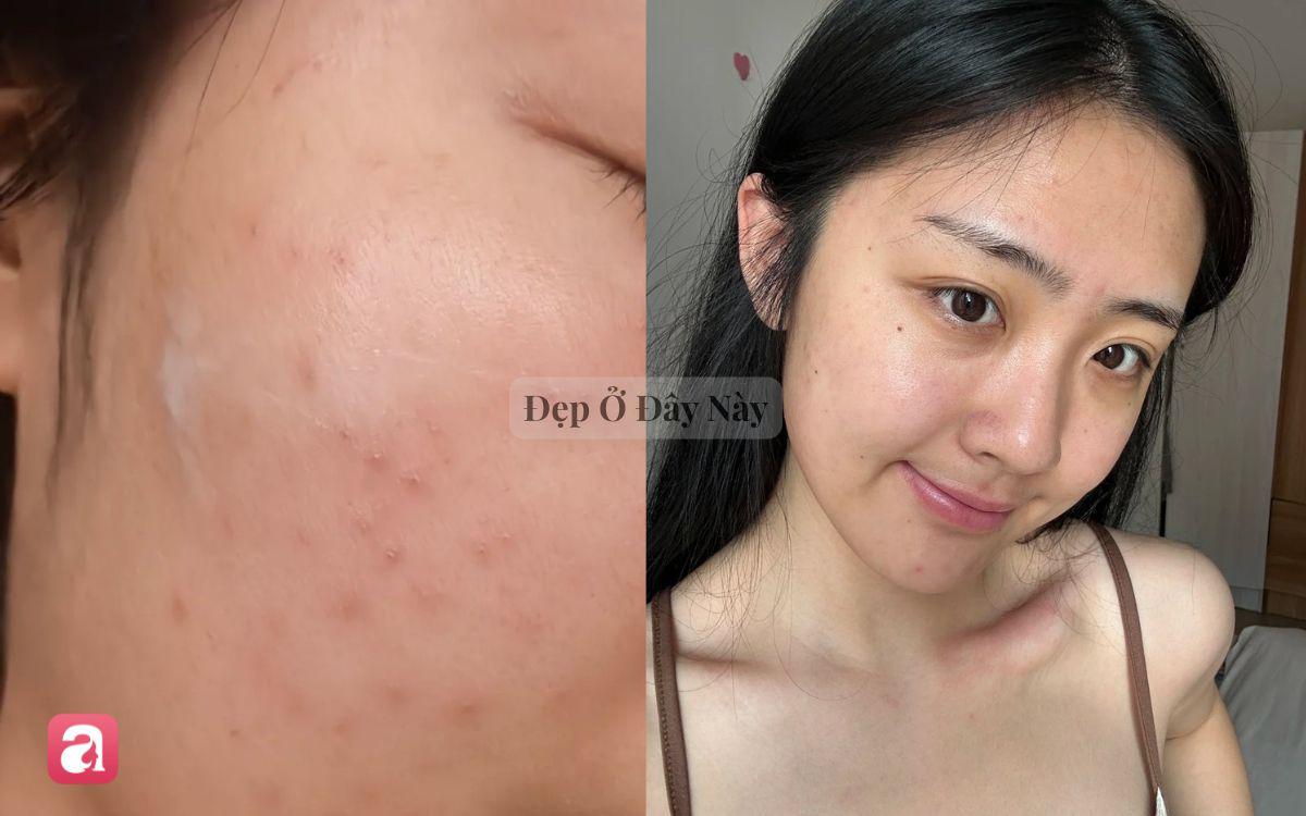 Tại sao chăm sóc da quá nhiều làm hỏng da và giải pháp tối giản
