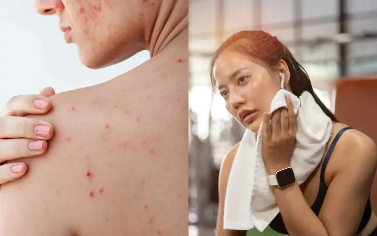 Chăm lưng đúng sau khi đổ mồ hôi: chìa khóa ngăn mụn lưng tái phát