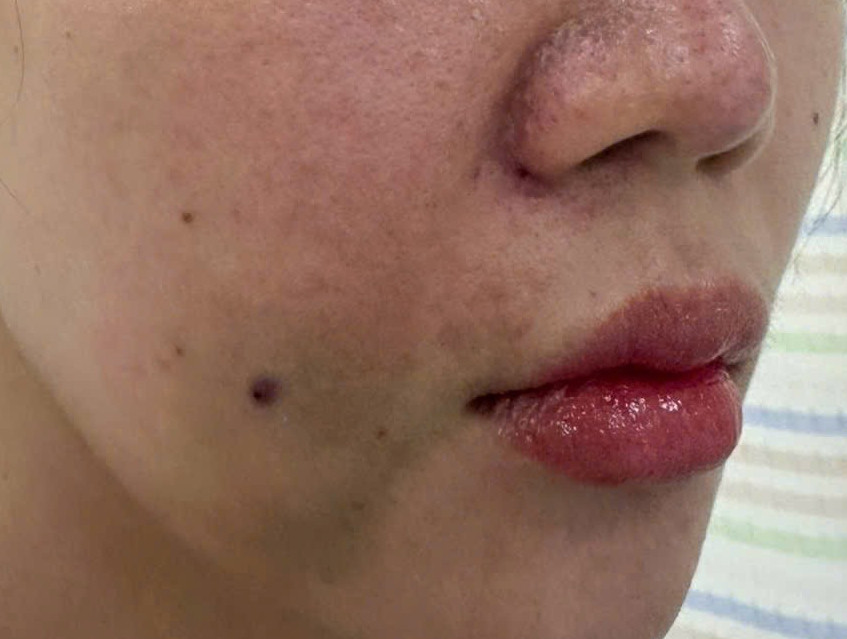 Tiêm filler tại spa: từ làm đẹp cấp tốc đến hoại tử mô mặt