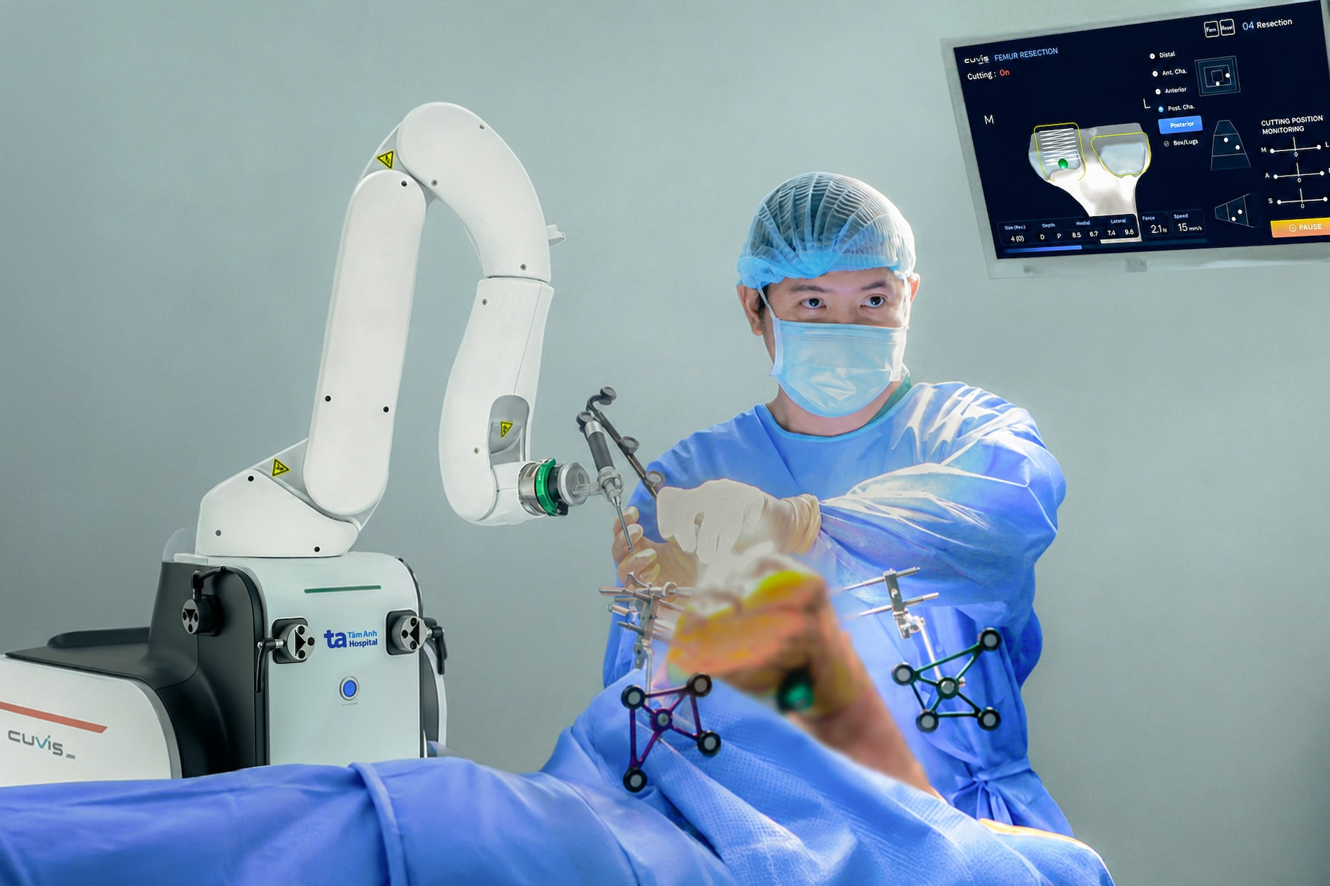 Vượt mốc 100 ca thay khớp khó: “siêu robot” AI CUVIS-Joint đang tạo chuẩn mới cho phẫu thuật