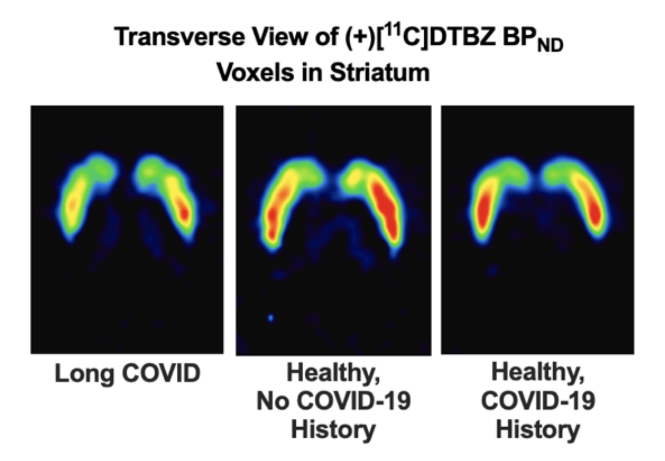 Long COVID Is Leaving Visible Scars on the Brain’s Dopamine System