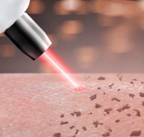 Post‑Laser Skincare Recovery: How to Heal After Ablative Resurfacing